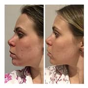 Tria Beauty Positively Clear Acne Clearing Blue Light