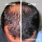 Hairmax LaserBand 82 Hair Band (FDA Cleared)