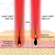 Hairmax Actonis 18 Dual Action Laser Comb 50 Watts 1030024